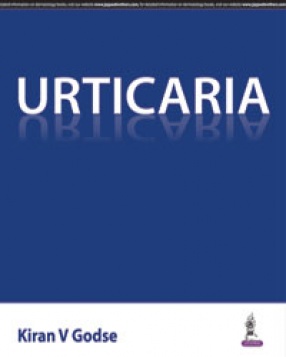 Urticaria